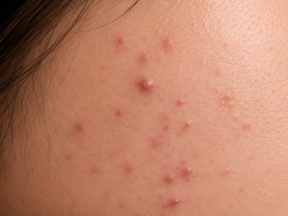 Acne Control