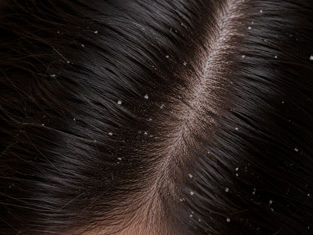 Anti Dandruff